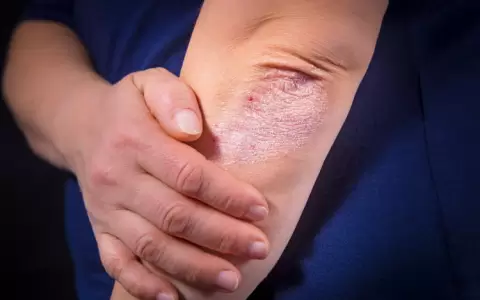 Psoriasis, una enfermedad poco difundida y muy frecuente