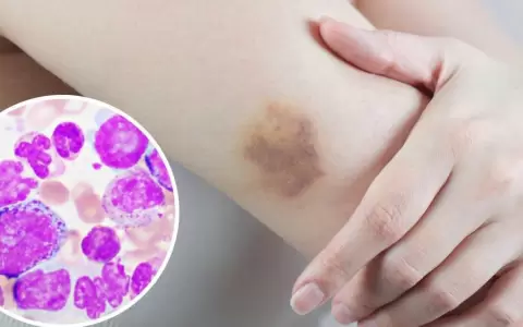 Leucemia mieloide aguda: instan a consultar y atender s�ntomas.
