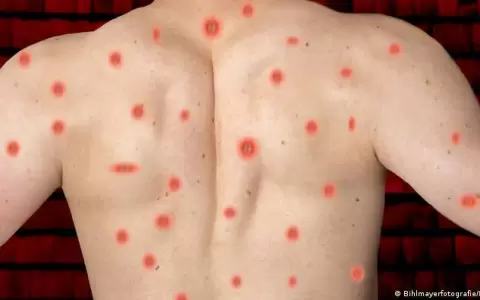 Viruela del mono: expertos brit�nicos presentan ensayo de tratamiento Tecovirimat