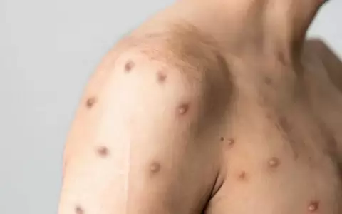 Viruela del mono: Salud insta a tomar recaudos