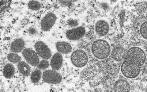 EE.UU. declar� emergencia sanitaria por el aumento de casos de viruela del mono
