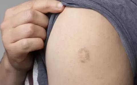 Emiten alerta en Amambay por caso de viruela del mono en Brasil