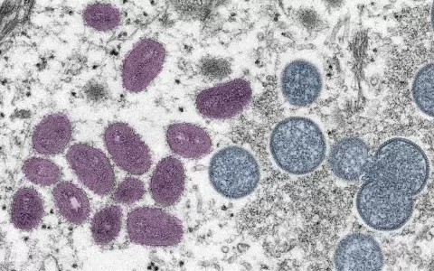Detectada en Italia la primera coinfecci�n de viruela del mono, covid y VIH en un hombre que viaj� a Espa�a