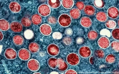 India confirma muerte de un hombre contagiado con viruela del mono