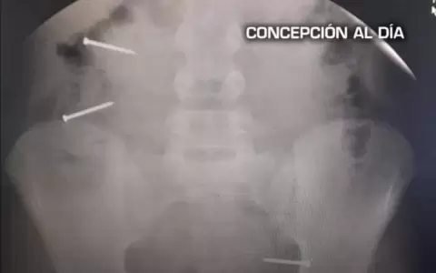 Concepci�n: ni�a se trag� tres clavos al realizar un reto de TikTok