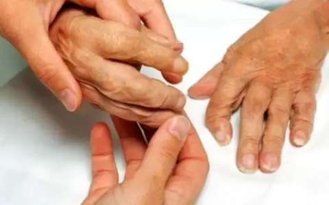 En el D�a Mundial de la Artritis Reumatoide, destacan cuidados y atenci�n a s�ntomas