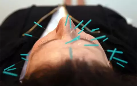 �Sirven la acupuntura y la homeopat�a para tratar el p�rkinson?