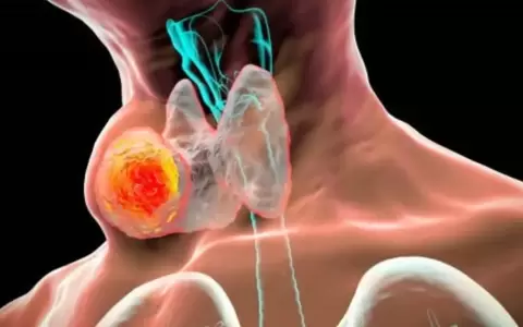 �Qu� alimentos debe evitar una persona que sufre de tiroides?