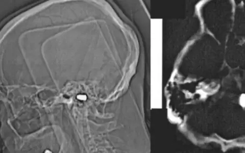 Por falta de tom�grafo en PJC, ni�a v�ctima de bala perdida fue tratada como si tuviese epilepsia