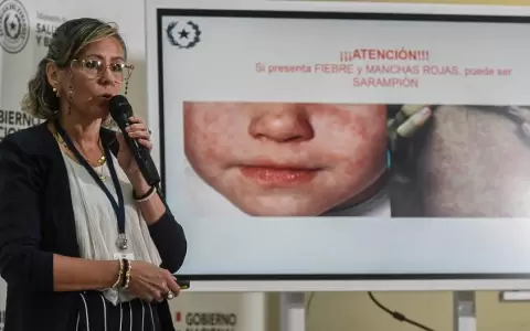 Salud intensificar� vigilancia ante brote de sarampi�n y s�ntomas similares a chikungu�a