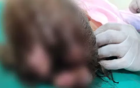 Ni�a de 4 a�os es internada por lesiones en la cabeza con gusanos y piojos