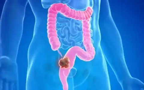�C�mo prevenir el c�ncer de colon, seg�n la Universidad de Harvard?