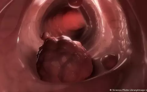 C�ncer de colon.