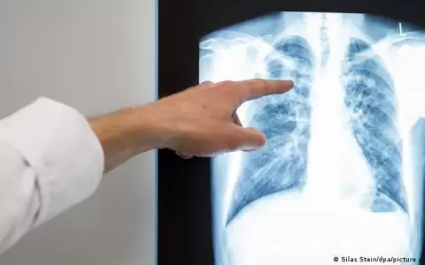 OMS advierte sobre un aumento de casos de tuberculosis en Europa