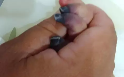 Amputar�n los deditos a una beb� por presunta negligencia m�dica