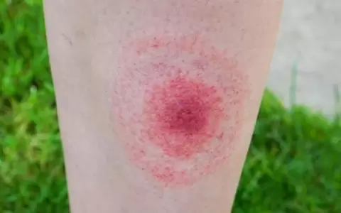 Lyme: enfermedad que padec�a Tina Turner y que se transmite por garrapatas