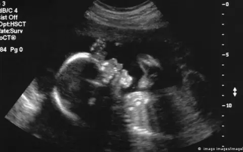 M�dicos logran realizar con �xito la primera cirug�a cerebral de un feto
