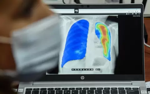 Realizan diagn�stico de tuberculosis en comunidades ind�genas por medio de radiograf�a digital