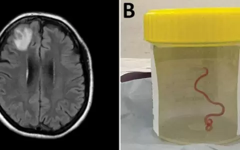 Investigadores encuentran por primera vez un gusano vivo en el cerebro de una mujer