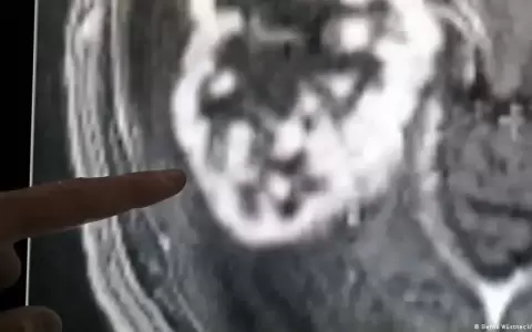 Aumenta el c�ncer entre adultos j�venes en el mundo