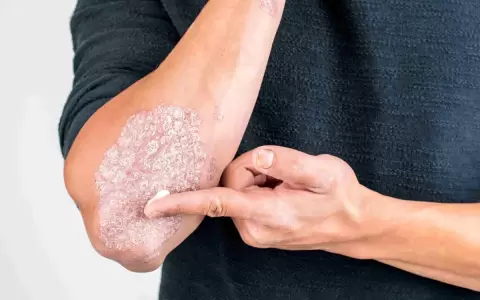 La Psoriasis es una enfermedad inflamatoria cr�nica.