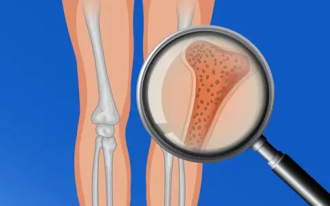 Hoy se recuerda el D�a Mundial de la Osteoporosis