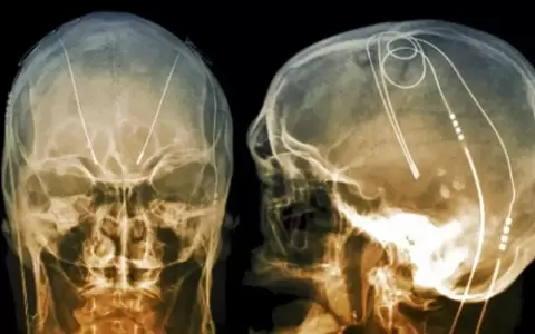 Parkinson: descubrimiento argentino clave para que la terapia celular funcione