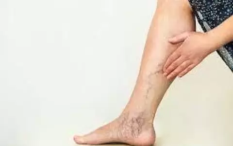 Estos son los alimentos que m�s inflaman las venas varicosas
