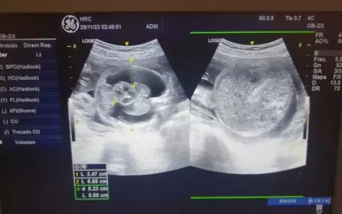 Realizan por primera vez exitosa cirug�a fetal para salvar a un ni�o antes de nacer
