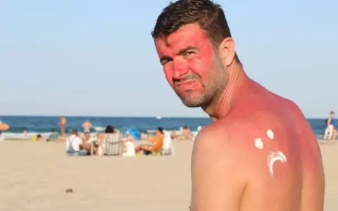 Exposici�n al sol en horarios cr�ticos puede causar da�os graves en la piel