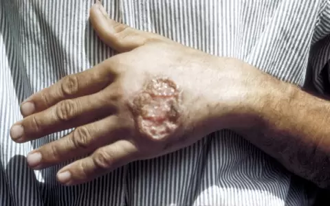 Alarma por aumento de casos de leishmaniasis en humanos en el pa�s
