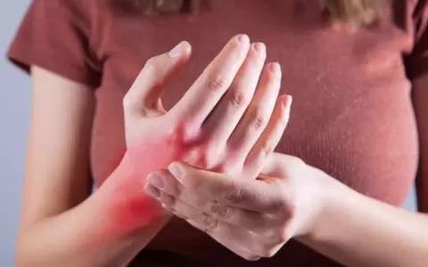 D�a Mundial del Lupus: �Qu� es y cu�les son sus s�ntomas?