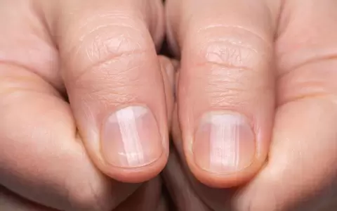 �Qu� significa tener las u�as rayadas?