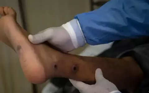 Argentina a�sla un buque por supuesto caso de mpox