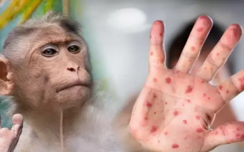 �Qu� es el mpox, c�mo se contagia y c�mo se puede prevenir?