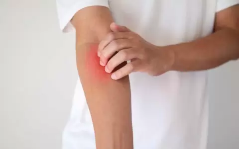 Dermatitis at�pica: nuevos abordajes para una molestia persistente.