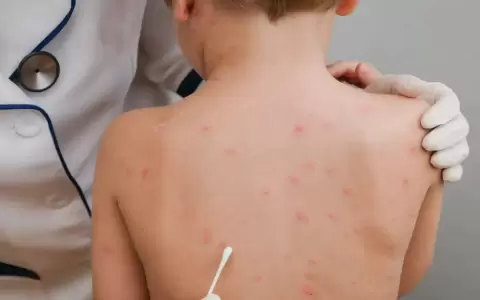 Salud insta a consultar ante casos de varicela, por su similitud con la viruela s�mica.