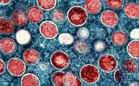Mpox: Am�rica Latina sigue "mal preparada"
