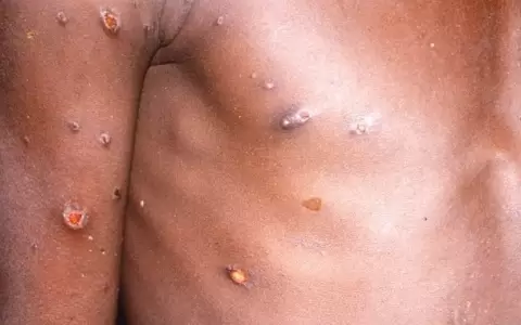 La OMS notifica 934 casos de viruela del mono en junio en todo el mundo, casi un 50% m�s que en mayo