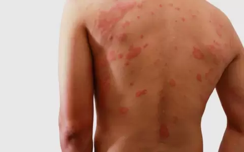 Dermatitis at�pica: cu�les son las dificultades m�s frecuentes que complican el acceso al tratamiento
