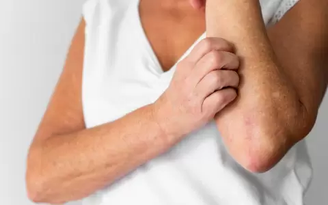 D�a Mundial de la Psoriasis: un nuevo paradigma en el tratamiento