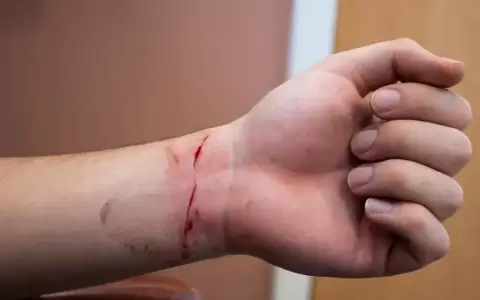 Alertan sobre el aumento de casos adolescentes con el s�ndrome de "cutting"