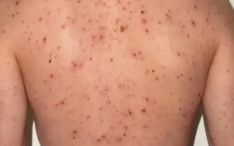 Casos de sarampi�n aumentaron 20% en el mundo y advierten sobre los riesgos de la baja vacunaci�n