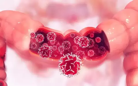 C�ncer intestinal aumenta entre j�venes de todo el mundo