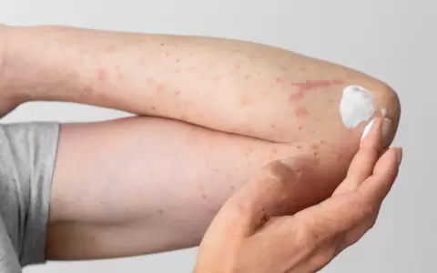 La psoriasis y el verano: cuidados para proteger la piel en �poca de altas temperaturas