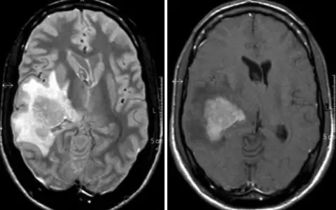 La edad es el principal factor de riesgo para padecer linfoma cerebral, seg�n experto