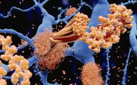 �Un virus del herpes muy extendido causa Alzheimer?