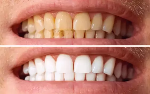 Dientes.