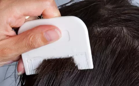 Salud insta a controlar el cuero cabelludo de los ni�os para evitar aparici�n de piojos