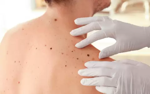 Melanoma: �c�mo detectar un lunar que podr�a ser c�ncer de piel?
